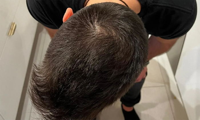 Case Topical Finasteride + Minoxidil · Norwood IV · 1 year — 3 Month