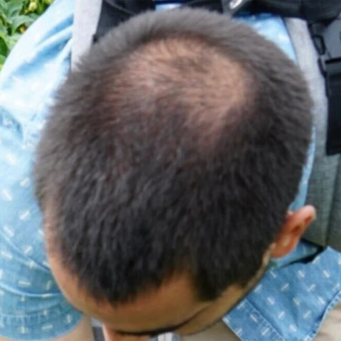 JV — before treatment