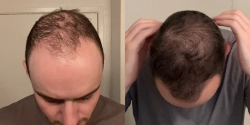 Zeph's before and after results with topical finasteride, showing noticeable hair regrowth and improved thickness