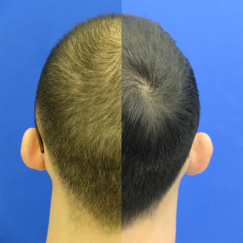 Geordie’s hair transformation with XYON topical dutasteride treatment, highlighting significant regrowth and improved density.