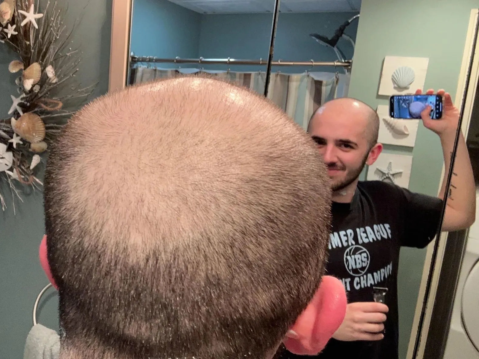 Xyon Topical Finasteride Reviews Real Stories And Results Xyon Topical Finasteride Reviews Real Stories And Results